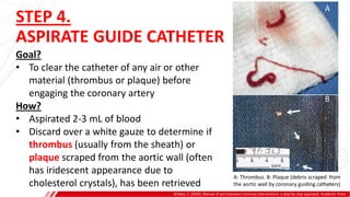 STEP 4.
ASPIRATE GUIDE CATHETER
Brilakis, E. (2020). Manual of percutaneous coronary interventions: a step-by-step approach. Academic Press.
Goal?
• To clear the catheter of any air or other
material (thrombus or plaque) before
engaging the coronary artery
How?
• Aspirated 2-3 mL of blood
• Discard over a white gauze to determine if
thrombus (usually from the sheath) or
plaque scraped from the aortic wall (often
has iridescent appearance due to
cholesterol crystals), has been retrieved
A
B
A: Thrombus. B: Plaque (debris scraped from
the aortic wall by coronary guiding catheters)
 