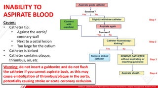 INABILITY TO
ASPIRATE BLOOD
Brilakis, E. (2020). Manual of percutaneous coronary interventions: a step-by-step approach. Academic Press.
A
B
Causes:
• Catheter tip:
• Against the aortic/
coronary wall
• Next to a ostial lesion
• Too large for the ostium
• Catheter is kinked
• Catheter contains plaque,
thrombus, air, etc
Warning: do not insert a guidewire and do not flush
the catheter if you cannot aspirate back, as this may
cause embolization of thrombus/plaque in the aorta,
potentially causing stroke or acute coronary occlusion.
 