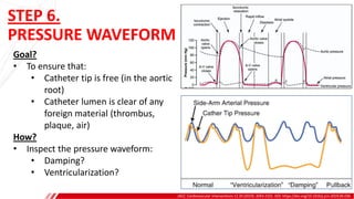 STEP 6.
PRESSURE WAVEFORM
JACC: Cardiovascular Interventions 12.20 (2019): 2093-2101. DOI: https://doi.org/10.1016/j.jcin.2019.06.036
Goal?
• To ensure that:
• Catheter tip is free (in the aortic
root)
• Catheter lumen is clear of any
foreign material (thrombus,
plaque, air)
How?
• Inspect the pressure waveform:
• Damping?
• Ventricularization?
A
B
 