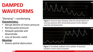 DAMPED
WAVEFORMS
J INVASIVE CARDIOL 2017;29(11):387-389.
A
B
“Damping” = overdamping
Characteristics:
• Abrupt decline of mean pressure
• Narrow pulse pressure
• Delayed upstroke and
downstroke
• Loss of dicrotic notch
Meaning:
• Severe partial obstruction
Figure 1: Pressure-wave damping. Note the abrupt decline of
coronary pressure with narrow pulse pressre and a delayed
upstroke and downstroke
Figure 2: Immediate pullback of the catheter  pressure
waveform returns back to baseline
 