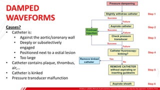 DAMPED
WAVEFORMS
Brilakis, E. (2020). Manual of percutaneous coronary interventions: a step-by-step approach. Academic Press.
Causes?
• Catheter is:
• Against the aortic/coronary wall
• Deeply or subselectively
engaged
• Positioned next to a ostial lesion
• Too large
• Catheter contains plaque, thrombus,
air,…
• Catheter is kinked
• Pressure transducer malfunction
A
B
 