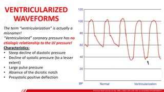 VENTRICULARIZED
WAVEFORMS
American Heart Journal, 01 Dec 1989, 118(6):1160-1166. DOI: 10.1016/0002-8703(89)90004-5
A
B
The term “ventricularization” is actually a
misnomer!
“Ventricularized” coronary pressure has no
etiologic relationship to the LV pressure!
Characteristics:
• Steep decline of diastolic pressure
• Decline of systolic pressure (to a lesser
extent)
• Large pulse pressure
• Absence of the dicrotic notch
• Presystolic positive deflection
 