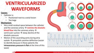 VENTRICULARIZED
WAVEFORMS
American Heart Journal, 01 Dec 1989, 118(6):1160-1166. DOI: 10.1016/0002-8703(89)90004-5
A
B
Causes:
• Catheter is:
• Positioned next to a ostial lesion
• Too large
Mechanism:
• Very small residual space between the catheter
and the coronary artery  restricts the diastolic
blood flow into the coronary artery 
ventricular suction  steep decline of the
diastolic pressure
• Motion of the ascending aorta during atria
systole  presystolic positive deflection (easier
to identify because in these patients the
intracoronary pressure is flat at the time of this
wave)
 