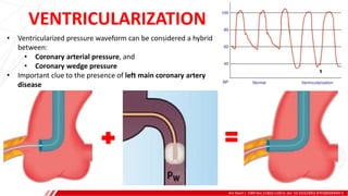 VENTRICULARIZATION
Am Heart J. 1989 Dec;118(6):1160-6. doi: 10.1016/0002-8703(89)90004-5.
A
B
• Ventricularized pressure waveform can be considered a hybrid
between:
• Coronary arterial pressure, and
• Coronary wedge pressure
• Important clue to the presence of left main coronary artery
disease
 