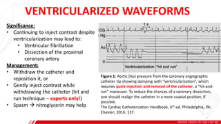 VENTRICULARIZED WAVEFORMS
J INVASIVE CARDIOL 2017;29(11):387-389.
A
B
Significance:
• Continuing to inject contrast despite
ventricularization may lead to:
• Ventricular fibrillation
• Dissection of the proximal
coronary artery
Management:
• Withdraw the catheter and
reposition it, or
• Gently inject contrast while
withdrawing the catheter (hit and
run technique – experts only!)
• Spasm  nitroglycerin may help
Figure 1: Aortic (Ao) pressure from the coronary angiographic
catheter tip showing damping with “ventricularization”, which
requires quick injection and removal of the catheter, a “hit-and-
run” maneuver. To reduce the chances of a coronary dissection,
one should realign the catheter in a more coaxial position, if
possible.
The Cardiac Catheterization Handbook. 6th ed. Philadelphia, PA:
Elsevier; 2016: 137.
 