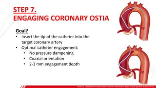 STEP 7.
ENGAGING CORONARY OSTIA
Brilakis, E. (2020). Manual of percutaneous coronary interventions: a step-by-step approach. Academic Press.
Goal?
• Insert the tip of the catheter into the
target coronary artery
• Optimal catheter engagement:
• No pressure dampening
• Coaxial orientation
• 2-3 mm engagement depth
A
B
 