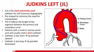 JUDKINS LEFT (JL)
http://cardiaccathpro.com/LeftCoronaryAngio.html
A
B
• JL4 is the most commonly used
catheter for Left Coronary Angiography
• Pre-shaped to minimize the need for
manipulation
• The 4 reflects the length of the
segment between the primary and
secondary curve
• Patients with a small or narrow aortic
arch will usually need a JL3.5 catheter
• Catheter is too short  tip pointed
upward
• Catheter is too long  tip pointed
downward
 