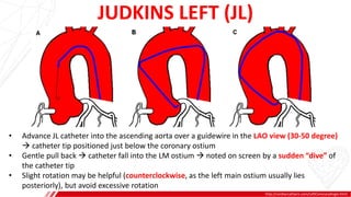 JUDKINS LEFT (JL)
http://cardiaccathpro.com/LeftCoronaryAngio.html
A
B
• Advance JL catheter into the ascending aorta over a guidewire in the LAO view (30-50 degree)
 catheter tip positioned just below the coronary ostium
• Gentle pull back  catheter fall into the LM ostium  noted on screen by a sudden “dive” of
the catheter tip
• Slight rotation may be helpful (counterclockwise, as the left main ostium usually lies
posteriorly), but avoid excessive rotation
 