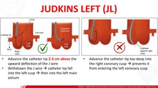 JUDKINS LEFT (JL)
Brilakis, E. (2020). Manual of percutaneous coronary interventions: a step-by-step approach. Academic Press.
A
B
• Advance the catheter tip 2-3 cm above the
upward deflection of the J wire
• Withdrawn the J wire  catheter tip fall
into the left cusp  then into the left main
ostium
• Advance the catheter tip too deep into
the right coronary cusp  prevents it
from entering the left coronary cusp
 