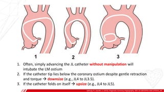 JUDKINS LEFT (JL)
Sakhuja, R., Gandhi, S. (2015). Diagnostic Coronary Angiography. DOI: 10.1007/978-3-642-37078-6_40.
A
B
1. Often, simply advancing the JL catheter without manipulation will
intubate the LM ostium
2. If the catheter tip lies below the coronary ostium despite gentle retraction
and torque  downsize (e.g., JL4 to JL3.5).
3. If the catheter folds on itself  upsize (e.g., JL4 to JL5).
 