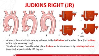 JUDKINS RIGHT (JR)
Sakhuja, R., Gandhi, S. (2015). Diagnostic Coronary Angiography. DOI: 10.1007/978-3-642-37078-6_40.
A
B
• Advance the catheter is over a guidewire in the LAO view to the valve plane (the bottom
of the right coronary cusp)
• Slowly withdrawn from the valve plane 2–4 cm while simultaneously rotating clockwise
(anterior) approximately 180 degree
 