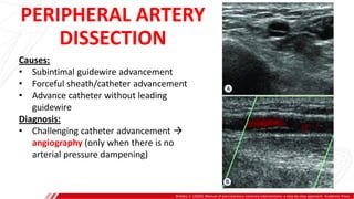 PERIPHERAL ARTERY
DISSECTION
Brilakis, E. (2020). Manual of percutaneous coronary interventions: a step-by-step approach. Academic Press.
Causes:
• Subintimal guidewire advancement
• Forceful sheath/catheter advancement
• Advance catheter without leading
guidewire
Diagnosis:
• Challenging catheter advancement 
angiography (only when there is no
arterial pressure dampening)
 