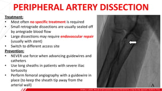 PERIPHERAL ARTERY DISSECTION
Brilakis, E. (2020). Manual of percutaneous coronary interventions: a step-by-step approach. Academic Press.
Treatment:
• Most often no specific treatment is required
• Small retrograde dissections are usually sealed off
by antegrade blood flow
• Large dissections may require endovascular repair
(usually with stent)
• Switch to different access site
Prevention:
• NEVER use force when advancing guidewires and
catheters
• Use long sheaths in patients with severe iliac
tortuosity
• Perform femoral angiography with a guidewire in
place (to keep the sheath tip away from the
arterial wall)
 