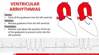VENTRICULAR
ARRHYTHMIAS
Brilakis, E. (2020). Manual of percutaneous coronary interventions: a step-by-step approach. Academic Press.
Causes:
• Entry of the guidewire into the left ventricle
Solution:
• Remove guidewire from the left ventricle
Prevention:
• Monitor and adjust the position of the tip
of the guidewire to prevent entry into the
left ventricle
 