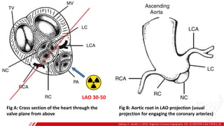 Sakhuja, R., Gandhi, S. (2015). Diagnostic Coronary Angiography. DOI: 10.1007/978-3-642-37078-6_40.
LAO 30-50
Fig B: Aortic root in LAO projection (usual
projection for engaging the coronary arteries)
Fig A: Cross section of the heart through the
valve plane from above
 