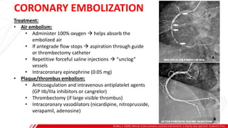 CORONARY EMBOLIZATION
Brilakis, E. (2020). Manual of percutaneous coronary interventions: a step-by-step approach. Academic Press.
Treatment:
• Air embolism:
• Administer 100% oxygen  helps absorb the
embolized air
• If antegrade flow stops  aspiration through guide
or thrombectomy catheter
• Repetitive forceful saline injections  “unclog”
vessels
• Intracoronary epinephrine (0.05 mg)
• Plaque/thrombus embolism:
• Anticoagulation and intravenous antiplatelet agents
(GP IIb/IIIa inhibitors or cangrelor)
• Thrombectomy (if large visible thrombus)
• Intracoronary vasodilators (nicardipine, nitroprusside,
verapamil, adenosine)
 