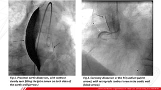 J Thorac Cardiovasc Surg 2006;131:230-10022-5223. DOi:10.1016/j.jtcvs.2005.08.051
Fig 1. Proximal aortic dissection, with contrast
clearly seen filling the false lumen on both sides of
the aortic wall (arrows)
Fig 2. Coronary dissection at the RCA ostium (white
arrow), with retrograde contrast seen in the aortic wall
(black arrow).
 