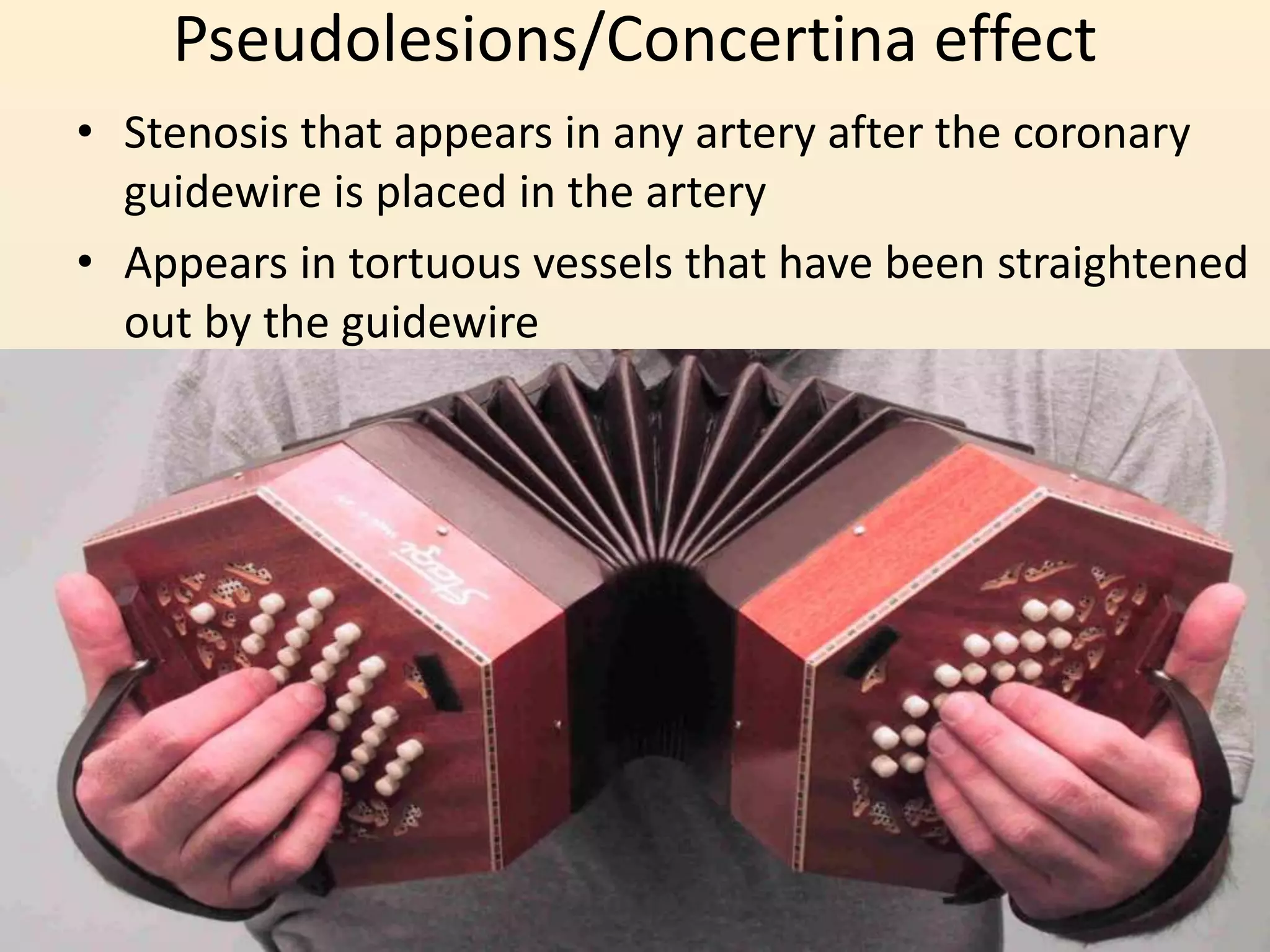 Pseudolesions/Concertina effect
• Stenosis that appears in any artery after the coronary
guidewire is placed in the artery
• Appears in tortuous vessels that have been straightened
out by the guidewire
 