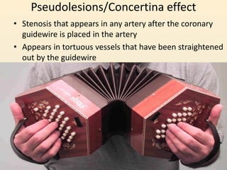 Pseudolesions/Concertina effect
• Stenosis that appears in any artery after the coronary
guidewire is placed in the artery
• Appears in tortuous vessels that have been straightened
out by the guidewire
 