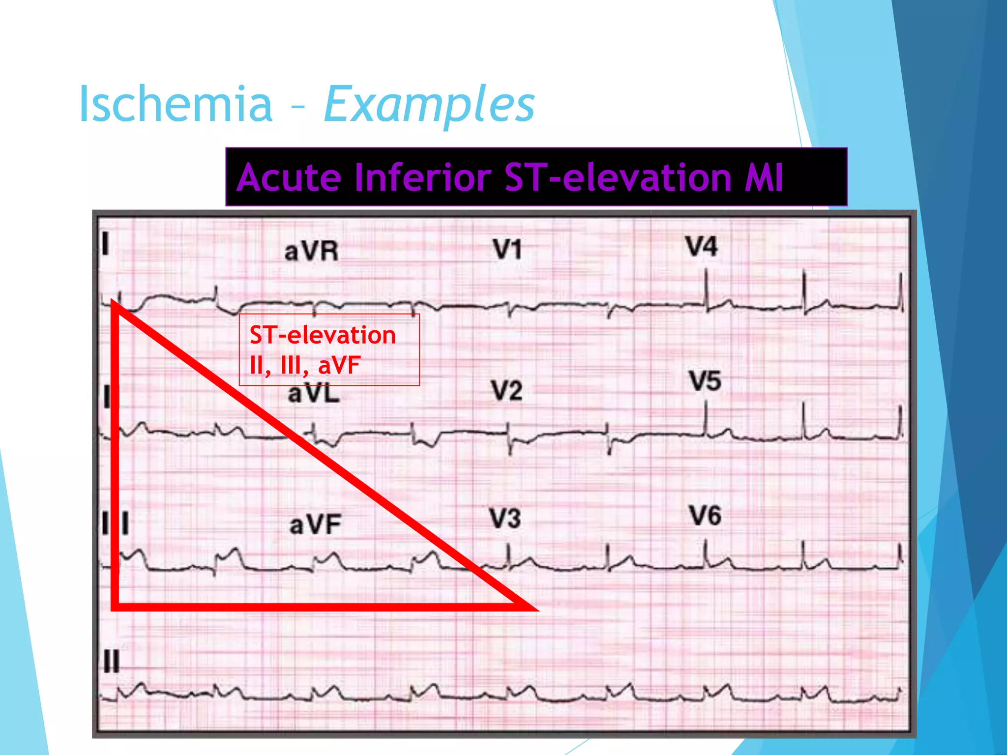 Ischemia – Examples
ST-elevation
II, III, aVF
Acute Inferior ST-elevation MI
 