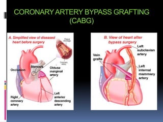 CORONARYARTERY BYPASS GRAFTING
(CABG)
 