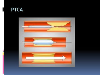 PTCA
 