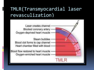 TMLR(Transmyocardial laser
revasculization)
 