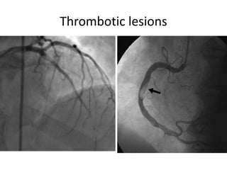 Thrombotic lesions
 