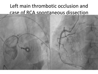 Left main thrombotic occlusion and
case of RCA spontaneous dissection
 