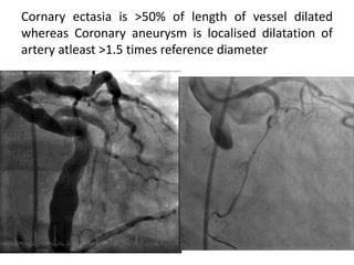 Cornary ectasia is >50% of length of vessel dilated
whereas Coronary aneurysm is localised dilatation of
artery atleast >1.5 times reference diameter
 