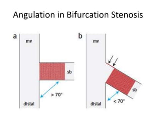 Angulation in Bifurcation Stenosis
 