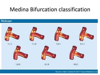 Medina Bifurcation classification
 