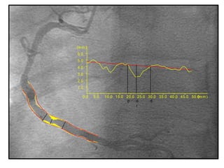 0.0 5.0 10.0 15.0 20.0 25.0 30.0 35.0 40.0 45.0 50.0(m m )
1.0
2.0
3.0
4.0
5.0
6.0
(m m )
op d
r
 