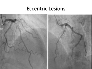Eccentric Lesions
 