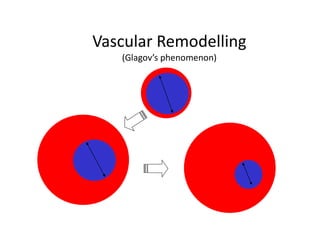 Vascular Remodelling
(Glagov’s phenomenon)
 