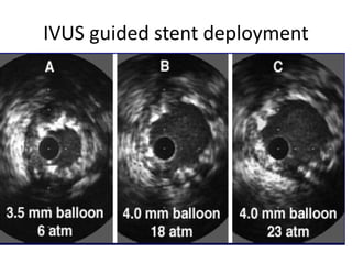 IVUS guided stent deployment
 