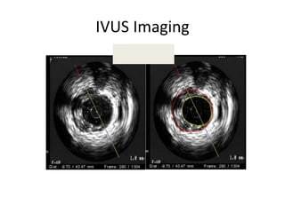 IVUS Imaging
2D Cross-Sectional
Imaging
 
