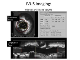 IVUS Imaging:
Plaque Surface and Volume
Longitudinal
Plane
Transverse
Plane
 
