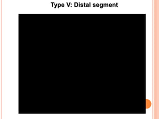 Type V: Distal segment
 