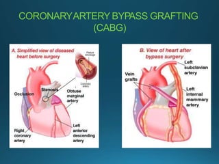 coronary ppt receate.pptx