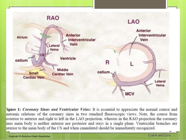 Coronary Sinus Anatomy