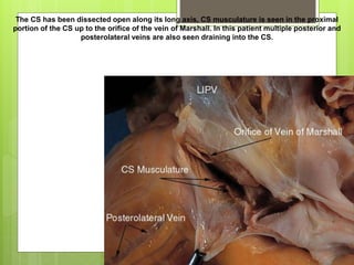 The CS has been dissected open along its long axis, CS musculature is seen in the proximal
portion of the CS up to the orifice of the vein of Marshall. In this patient multiple posterior and
posterolateral veins are also seen draining into the CS.
 