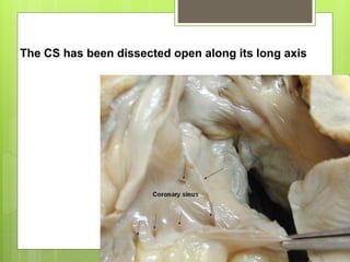 The CS has been dissected open along its long axis
 