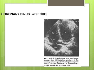 CORONARY SINUS -2D ECHO
 