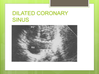 DILATED CORONARY
SINUS
 