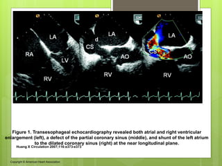 Figure 1. Transesophageal echocardiography revealed both atrial and right ventricular
enlargement (left), a defect of the partial coronary sinus (middle), and shunt of the left atrium
to the dilated coronary sinus (right) at the near longitudinal plane.
Huang X Circulation 2007;116:e373-e373
Copyright © American Heart Association
 