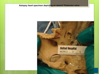 Autopsy heart specimen depicting an absent Thebesian valve.
 