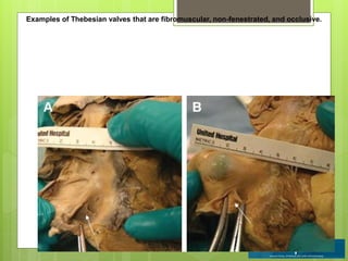 Examples of Thebesian valves that are fibromuscular, non-fenestrated, and occlusive.
 