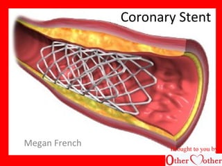 Coronary Stent
Megan French
Brought to you by
 
