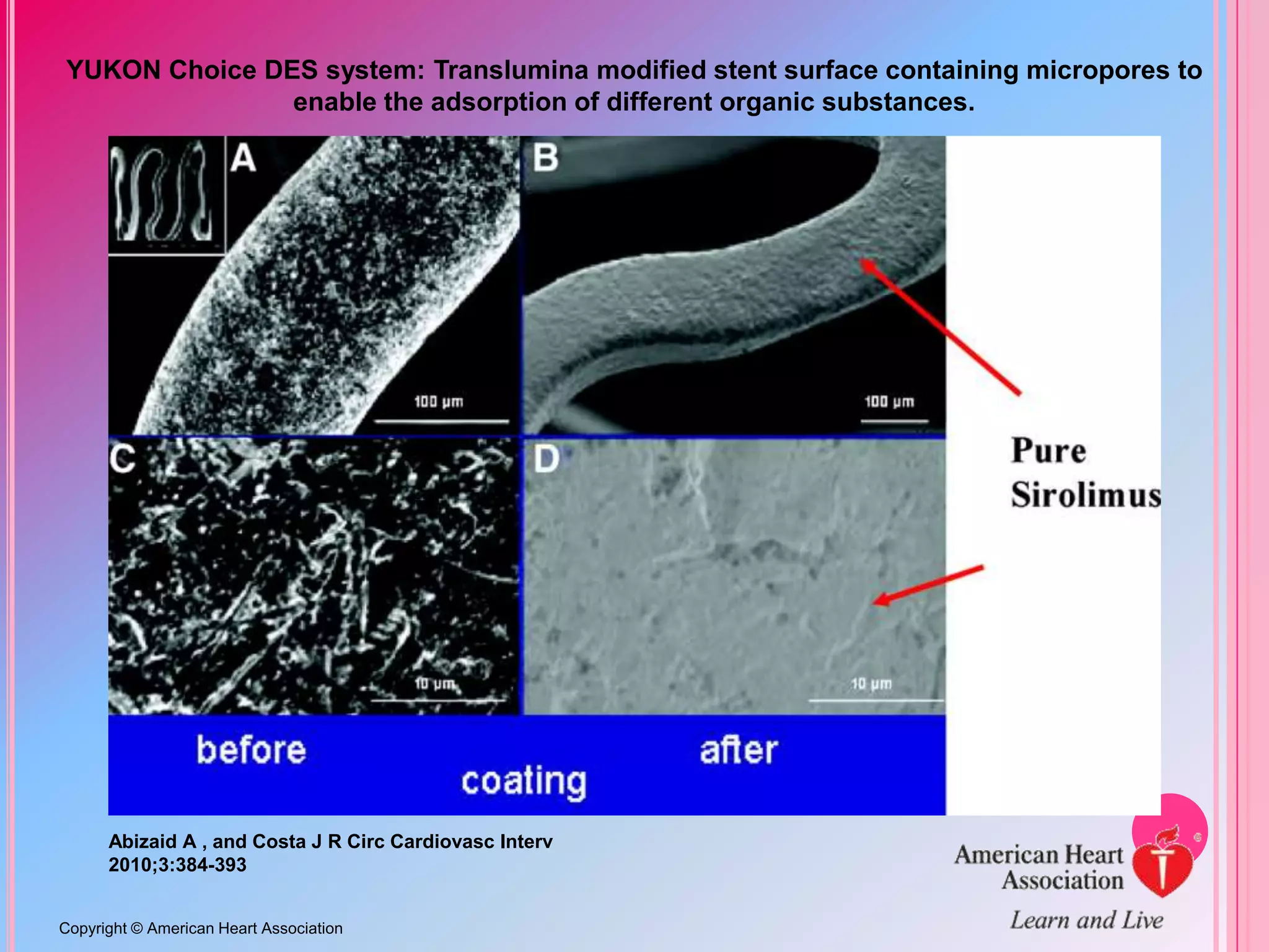 YUKON Choice DES system: Translumina modified stent surface containing micropores to
enable the adsorption of different organic substances.

Abizaid A , and Costa J R Circ Cardiovasc Interv
2010;3:384-393
Copyright © American Heart Association

 